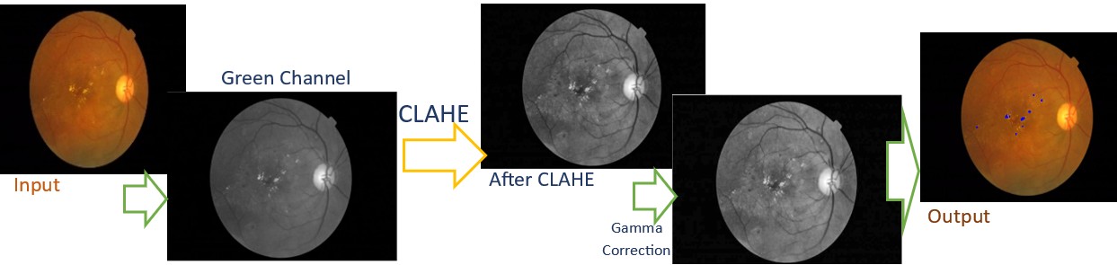 Diabetic Retinopathy detection